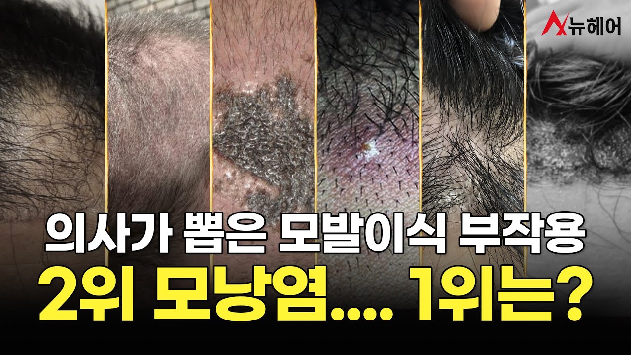 모발이식 부작용의 모든 것이 궁금하다면?! 필수시청