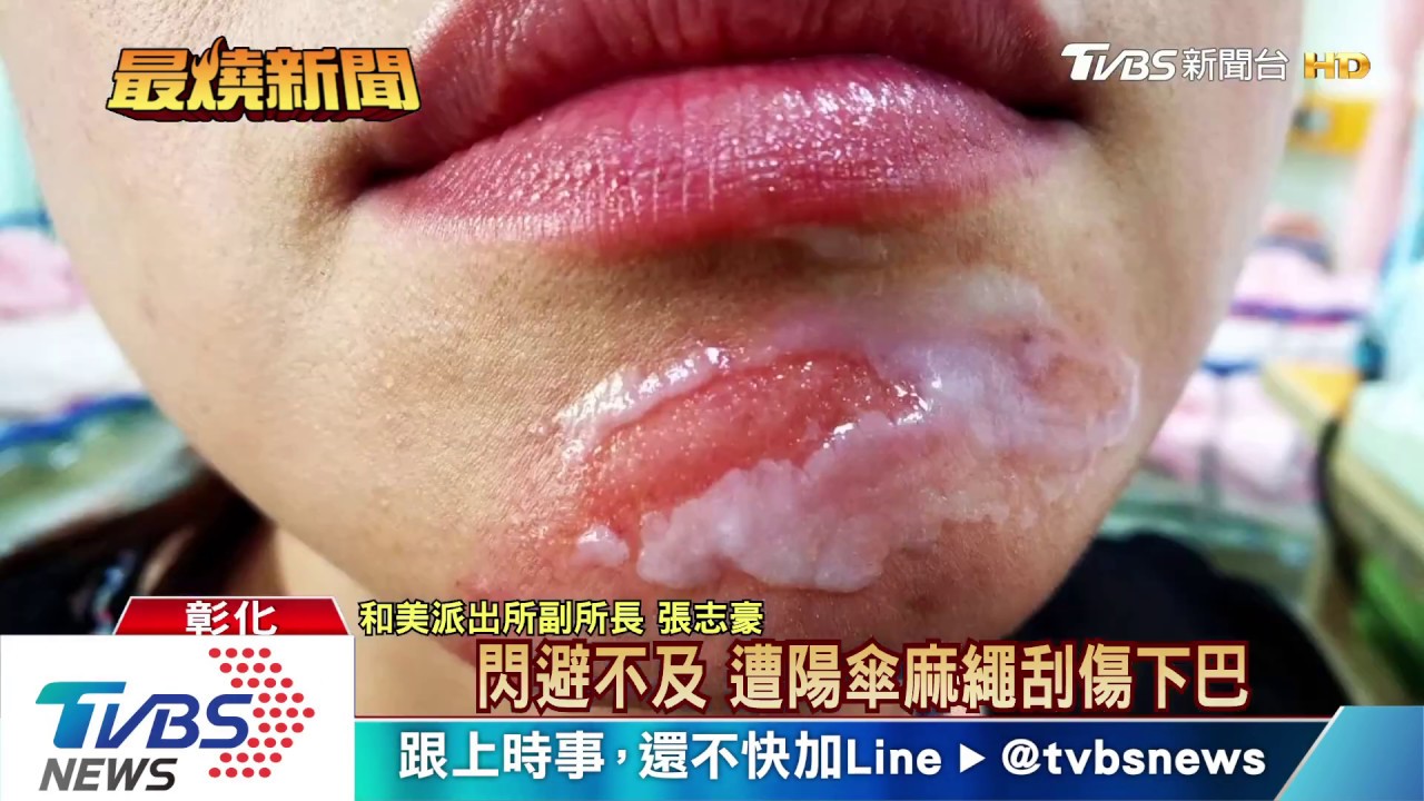 風吹倒陽傘 女騎士遭固定繩削下巴鎖喉