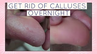 HOW TO GET RID OF CALLUSES ON FEET OVERNIGHT
