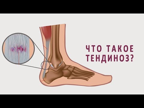 Остеохондроз лечение от нсп Боль и шеи с правой стороны