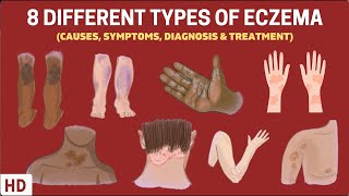 Eczema Exposed: 8 Types You Need to Know