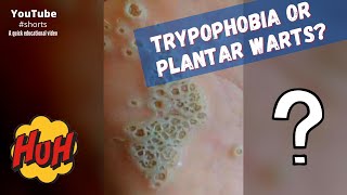 Download lagu Trypophobia or plantar warts? #shorts mp3