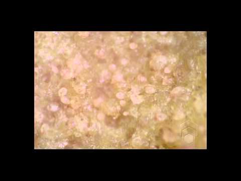Scabies mites on skin crust