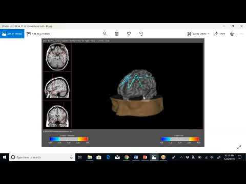 Webinar  Functional Brain Mapping and Neuromodulation  In the Treatment of Autism