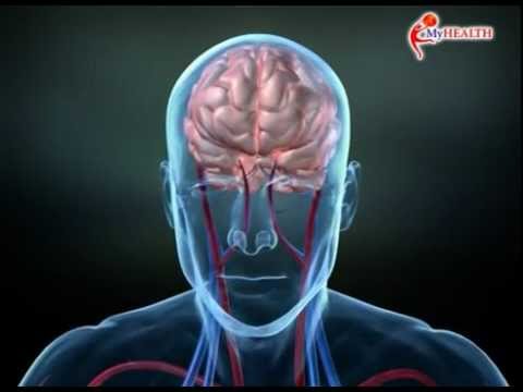 Torus palu Mjolnir Penyebab diabetes impotensi