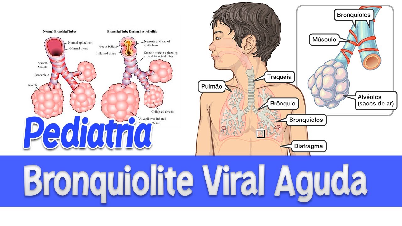 O que é a Bronquiolite Viral Aguda? │ Pediatria