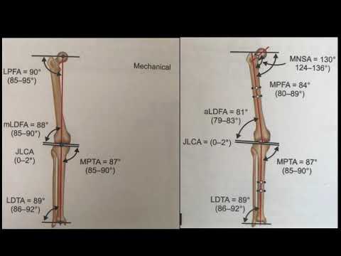 Understanding Alignment and Varus Knee for Total Knee Replacement