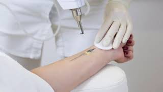 Why Laser Tattoo Removal Is The Better Option For Cover-Ups?