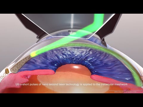 Selective Laser Trabeculoplasty (SLT) for glaucoma