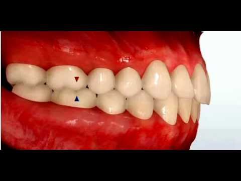 Class II Malocclusion