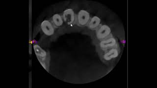 Management of Internal-external resorption in a maxillary incisor.