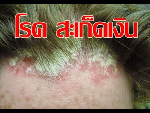 ขี้ผึ้ง glucocorticosteroid สำหรับโรคสะเก็ดเงิน ร้องไห้อาหารกลาก