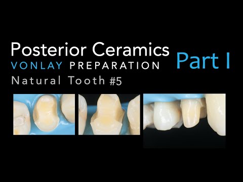 Zirconia Ceramics, Part 1: Vonlay Preparation #5 Natural Tooth