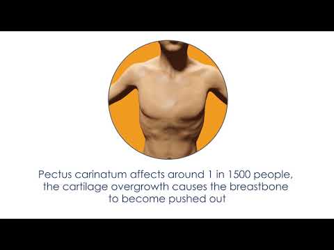 What is Pectus Carinatum?