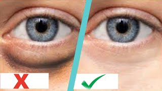 IN 7 DAYS REMOVE UNDER EYE BAGS  | REMOVE WRINKLES, PUFFY EYES, DARK CIRCLES | Khichi Beauty