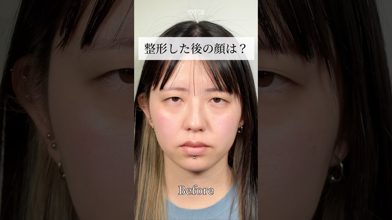 【二重整形】整形した後の顔は？ #shorts