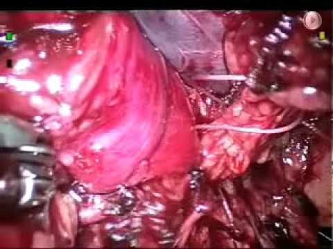 Ureteral Reconstruction