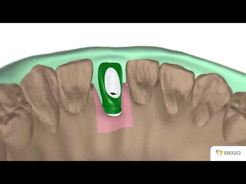 BEGO Implant Systems – Universal Aufbau / Universal abutment