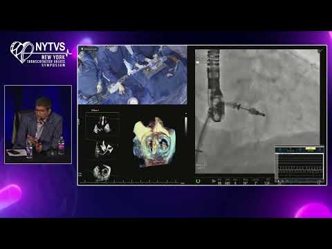 LIVE CASE 1 - Transcatheter Mitral Edge-to-Edge Repair Using MitraClip G4