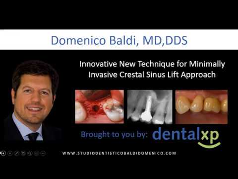 Webinar Dr. Baldi — Sinus lift with Magnetic Mallet