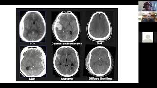 Imaging in Brain Trauma: Principals, Nuances and Future Directions by Mr Regunath Kandasamy