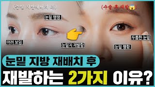 많은 연예인들이 수술 받고 좋은 효과를 봤던 눈 밑 지방재배치.. 그런데 재발하는 경우도 많다고..?!