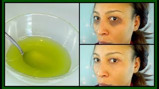 HOW TO GET RID OF DARK CIRCLES UNDER THE EYES, EYE BAGS, PUFFY EYES + ITCHING EYES  |Khichi Beauty