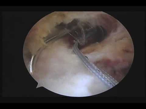 Arthroscopic Correction Of Rotator Cuff Due To Partial Rupture 