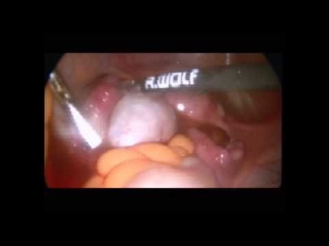 Suspected ectopic pregnancy with unusual findings