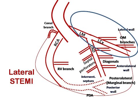 ECG course: Culprit in Lateral STEMI, Dr. Sherif Altoukhy
