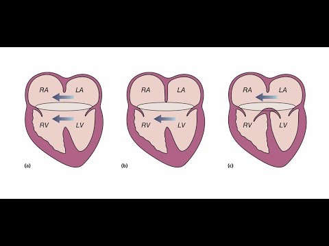 1. Anaesthesia management of CHD: AVSD