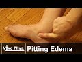 Pitting Edema - Example