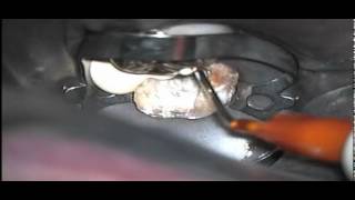 Download lagu Simplified Sealing of a Rubber Dam with Dycal (Endodontic Technique) mp3 Download lagu Simplified Sealing of a Rubber Dam with Dycal (Endodontic Technique) mp3