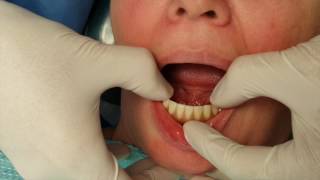 Implant Overdenture - Ankylos Syncone Protocol