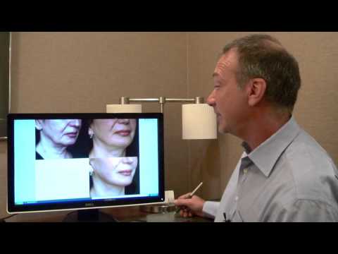 Deep Plane Facelifts