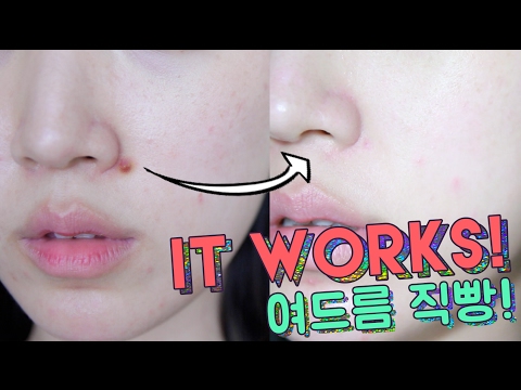 S.O.S Skincare Routine for Acne // How To Calm Down Acne FAST & IT WORKS! 🌴 Liah Yoo Video