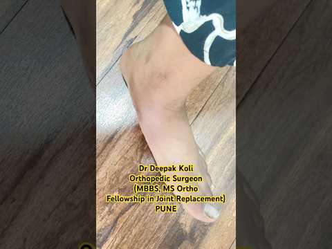 FLAT FOOT TREATMENT - ORTHOPEDIC SURGEON # Pune # Dr Deepak Koli