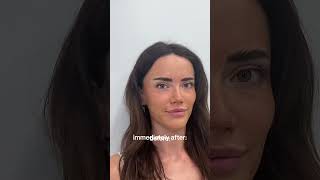 MIRCONEEDLING: achieve the face of an angel 👼 #bookedonupkeep