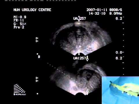 Transrectal Ultrasound Prostate Biopsy - Periprostatic Nerve Block