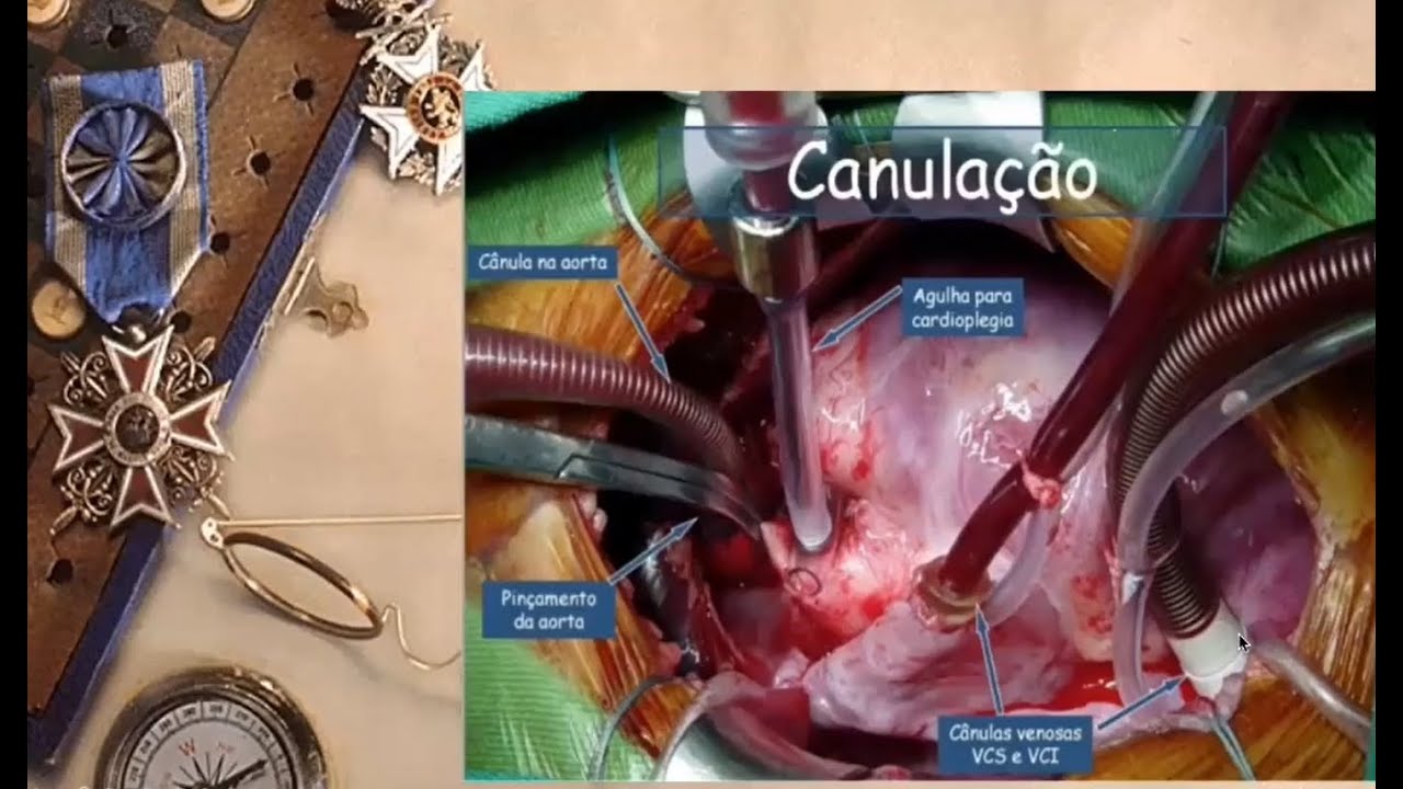 Circulação extra corpórea (CEC) - parte 1