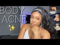 MUST HAVE Products That Are Effective Against BODY ACNE Best Products For Back Chest Acne