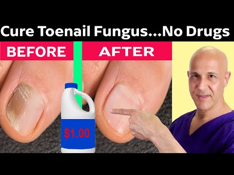 YouTube video about: Does uv light kill toe fungus?