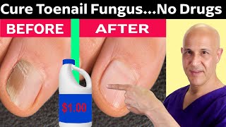 How to Cure Toenail Fungus for Pennies a Day!  Dr. Mandell