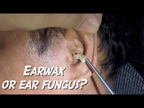 Paa halamang-singaw mas mura katapat Mga gamot na mabisa laban sa kuko halamang-singaw