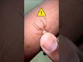 Brown Recluse BITE ATTEMPT ️
