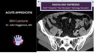 ACUTE APPENDICITIS: Mini Lecture, Dr. John Haggstrom, MD