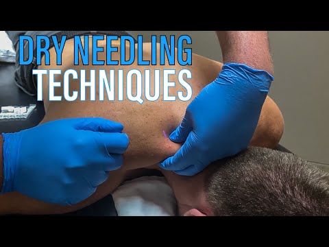 乾針療法：Derek Brady 獨家示範！ (Dry Needling Therapy featuring Derek Brady)
