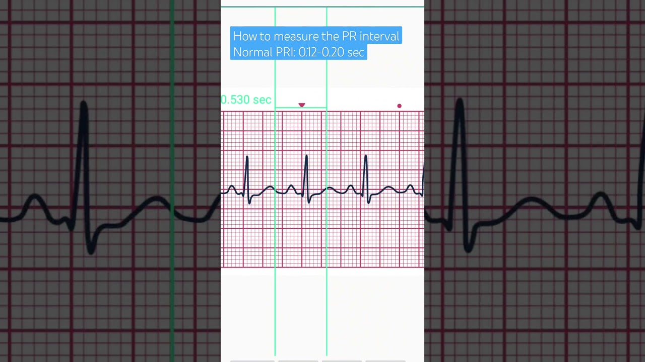 How to measure the PR interval