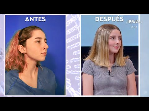 Rhinoplasty in Mexico City, Mexico by Dr. Ary Papadopulos