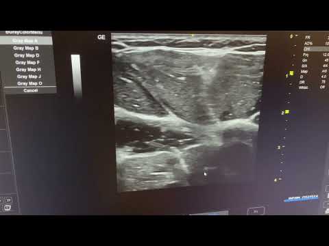MSK ultrasound shoulder - Demonstration biceps short and long axis